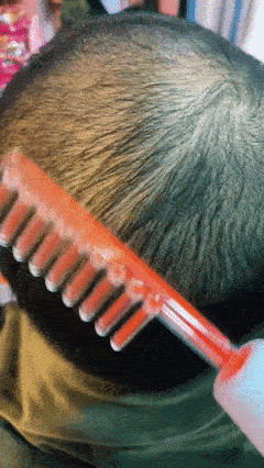 Kit de Alta Frecuencia Portátil 4 en 1 – Piel Limpia, Acné Controlado y Cabello Más Fuerte